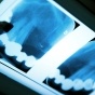 Dental X-Rays. 