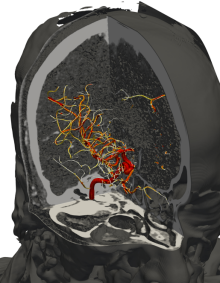3D rendering of the brain CT angiography from a patient with cerebrovascular disease. 