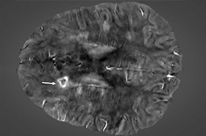 An image of the brain of a 45-year-old female with secondary-progressive MS that has a paramagnetic rim lesion. 
