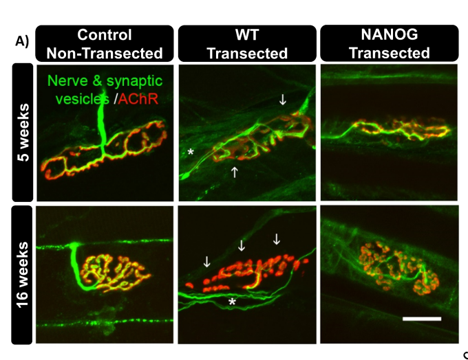 The images above show neuromuscular junctions in a control group (left images), a group with a sciatic injury (middle images), and a group with a sciatic injury where NANOG was expressed. The green shows presynaptic axons and synaptic vesicles; the red shows postsynaptic acetylcholine receptors (AChRs); and the yellow shows regions of overlap between the two. The asterisks indicate multiple innervations, and the arrows show areas of poor reinnervation. Credit: University at Buffalo. 