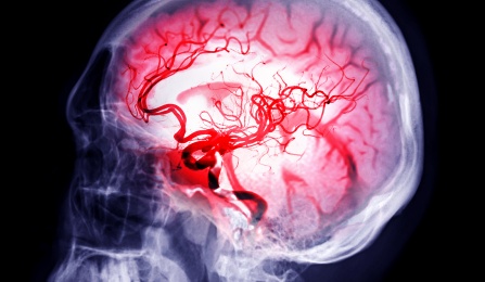 xray of brain aneurysm. 