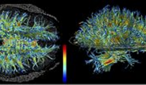 This image shows brain white matter tracts. These tracts facilitate communication between different regions of the brain, and are adversely affected in Krabbe disease. 