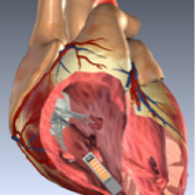 pacemaker. 