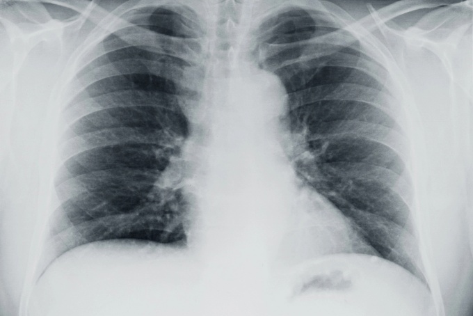 Image of a chest X-ray. 